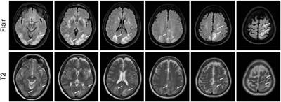 Posterior reversible encephalopathy syndrome associated with use of anlotinib to treat squamous cell carcinoma of the cervix: case report and literature review